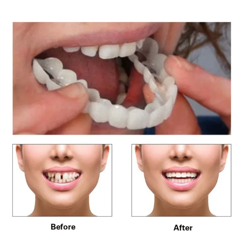 Teeth Whitening Session - Denture Cover Veneer Snap-on Teeth Kit