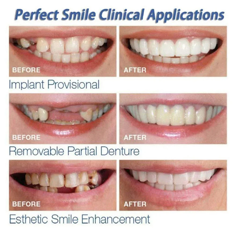 Veneer Snap-on Teeth Kit Fake  - огляд і ціна Teeth Whitening Session
