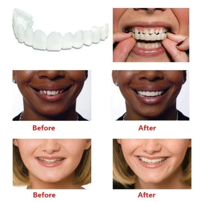 Denture Cover Veneer Snap-on T - огляд і ціна Teeth Whitening Session