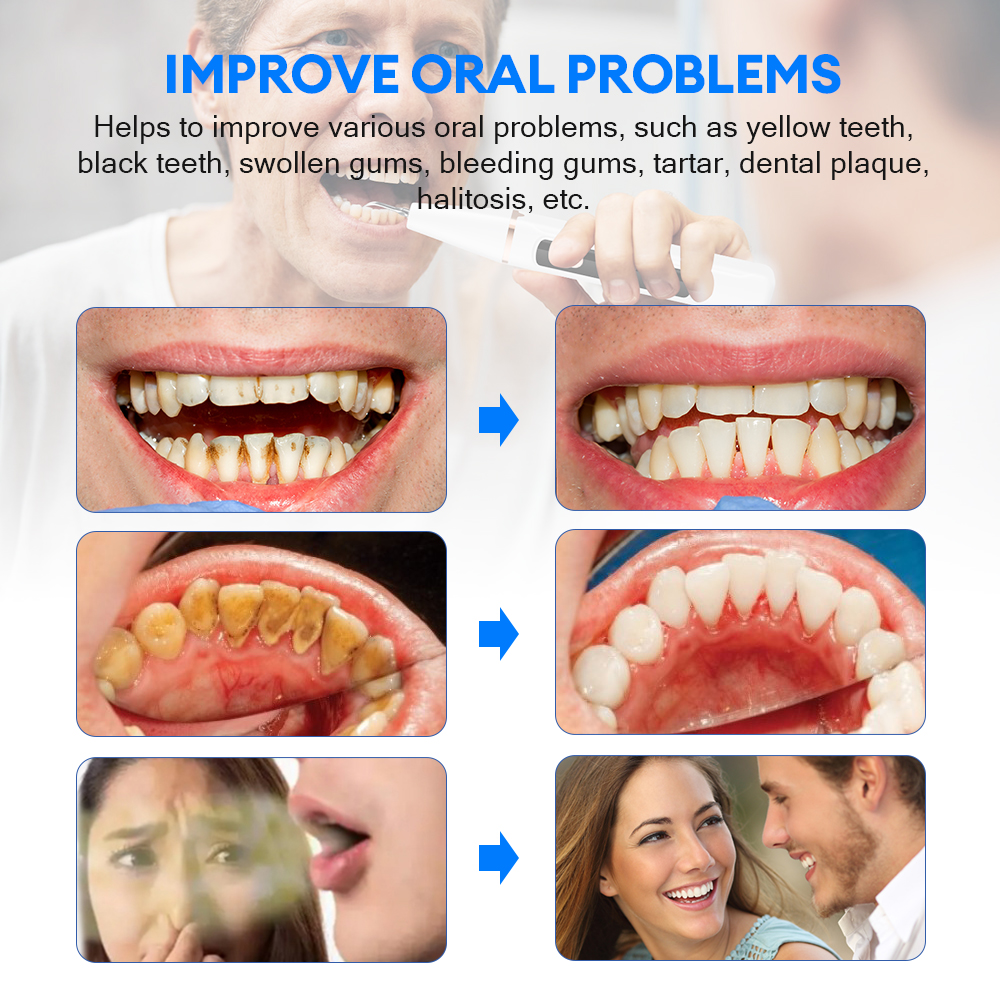 Electric Ultrasonic Dental Sca - огляд і ціна Teeth Whitening Express