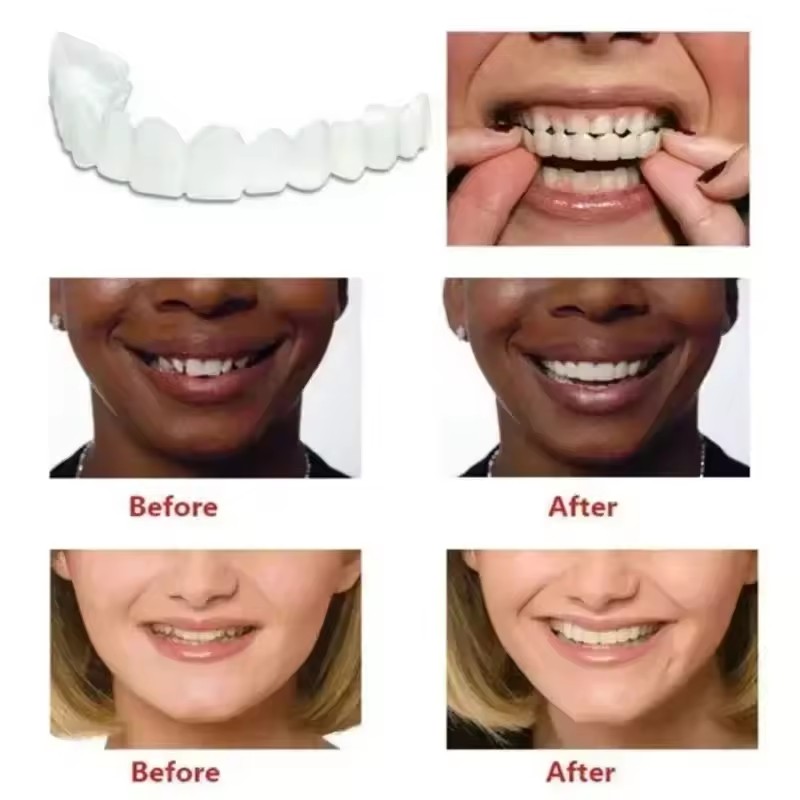 Teeth Veneers Whitening Dentur - огляд і ціна Teeth Whitening Session