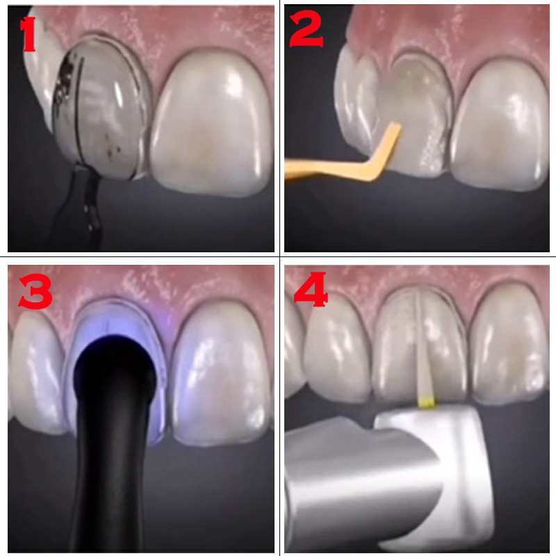 Dental Mould For Composite Res - огляд і ціна Teeth Whitening Moulds