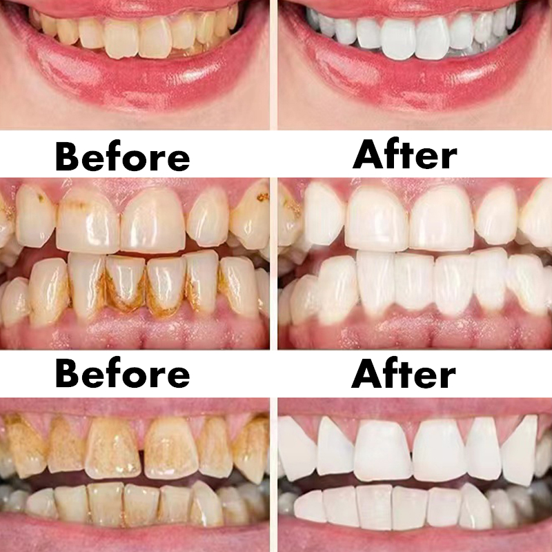 Teeth Whitening Pen Dental Ess - огляд і ціна Teeth Whitening Serum