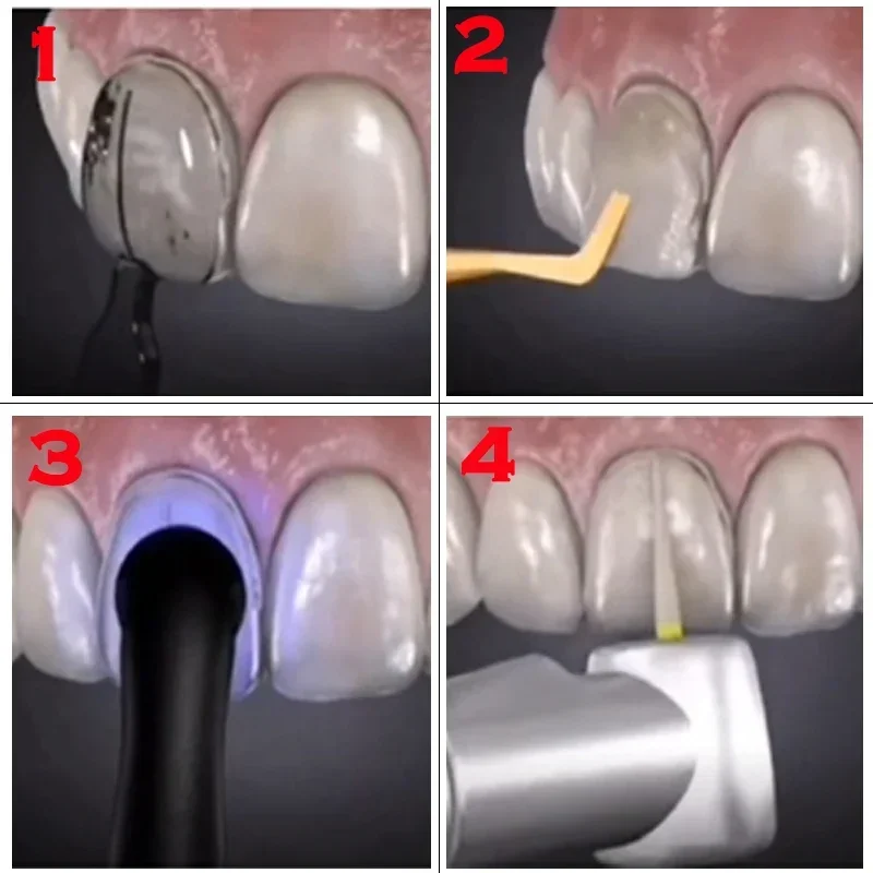 Dental Mould For Composite Res - огляд і ціна Teeth Whitening Moulds